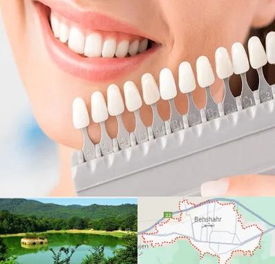 متخصص لمینت دندان در بهشهر