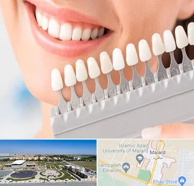 متخصص لمینت دندان در ملارد