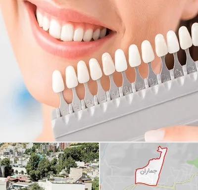 متخصص لمینت دندان در جماران