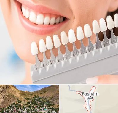 متخصص لمینت دندان در فشم