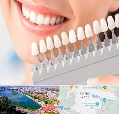 متخصص لمینت دندان در لاهیجان