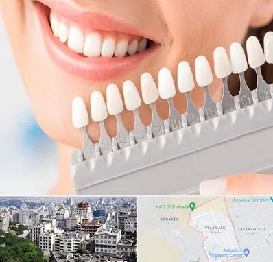 متخصص لمینت دندان در ولنجک 