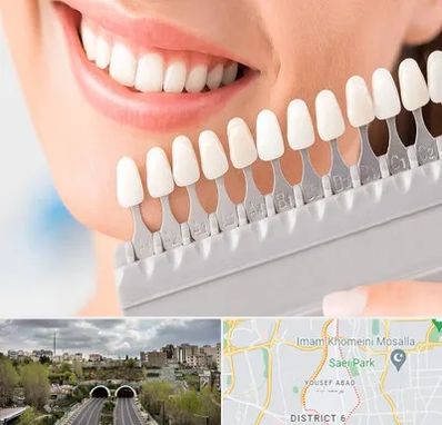 متخصص لمینت دندان در یوسف آباد 