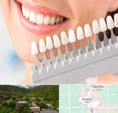 متخصص لمینت دندان در کلاله