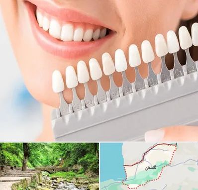 متخصص لمینت دندان در گلستان
