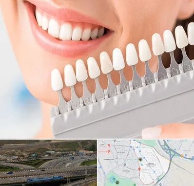 متخصص لمینت دندان در یاغچیان تبریز