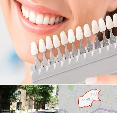 متخصص لمینت دندان در دزاشیب