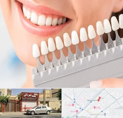 متخصص لمینت دندان در باجک قم