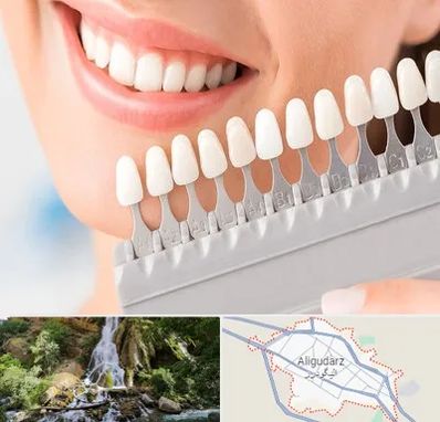 متخصص لمینت دندان در الیگودرز
