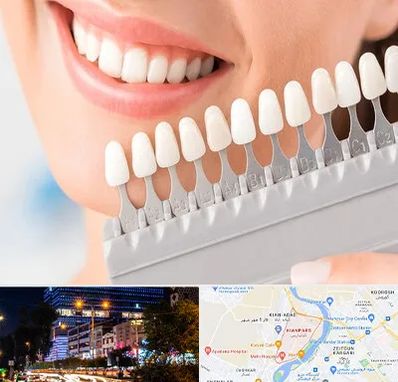 متخصص لمینت دندان در کیانپارس اهواز