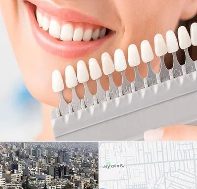 متخصص لمینت دندان در جیحون