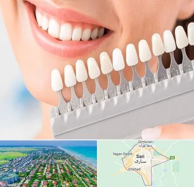 متخصص لمینت دندان در ساری