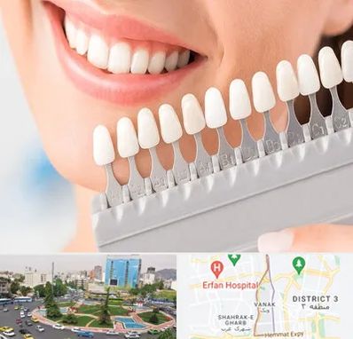 متخصص لمینت دندان در ونک 