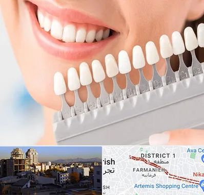 متخصص لمینت دندان در فرمانیه 