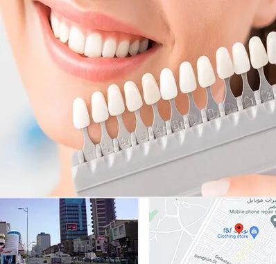 متخصص لمینت دندان در چهارراه طالقانی کرج