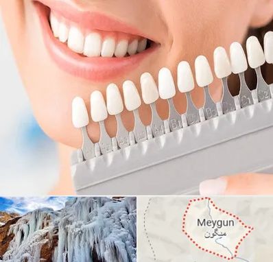 متخصص لمینت دندان در میگون