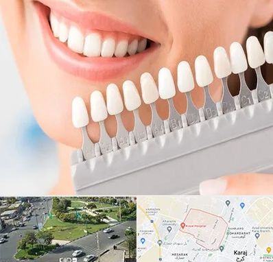 متخصص لمینت دندان در شاهین ویلا کرج