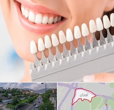 متخصص لمینت دندان در لویزان