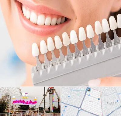 متخصص لمینت دندان در پادادشهر اهواز