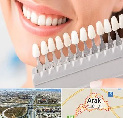 متخصص لمینت دندان در اراک