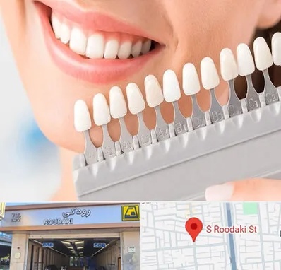 متخصص لمینت دندان در رودکی