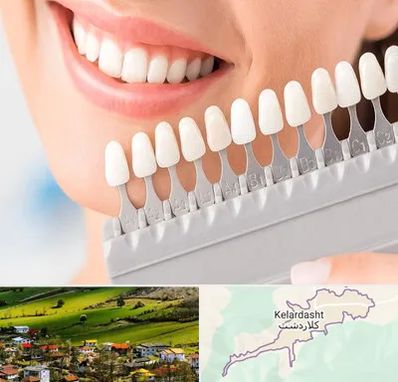 متخصص لمینت دندان در کلاردشت