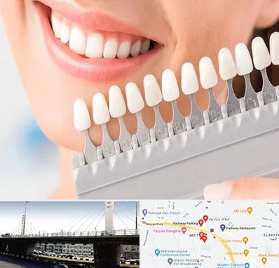 متخصص لمینت دندان در پارک وی 