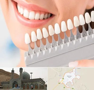 متخصص لمینت دندان در شهرضا