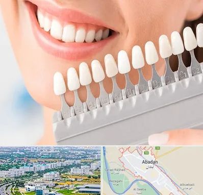 متخصص لمینت دندان در آبادان