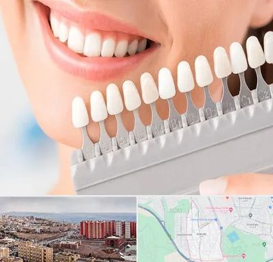 متخصص لمینت دندان در سهند تبریز