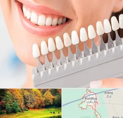 متخصص لمینت دندان در کردکوی