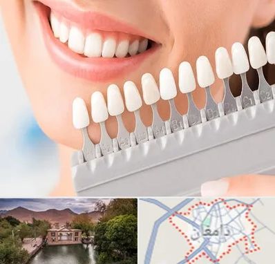 متخصص لمینت دندان در دامغان