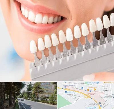 متخصص لمینت دندان در مهرویلا کرج