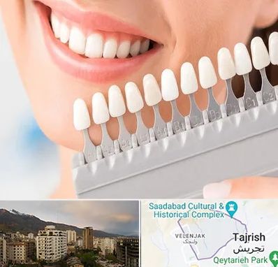 متخصص لمینت دندان در زعفرانیه 