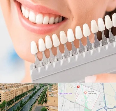 متخصص لمینت دندان در فاز سه اندیشه
