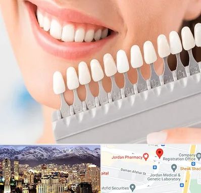 متخصص لمینت دندان در جردن 