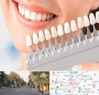 متخصص لمینت دندان در شریعتی 