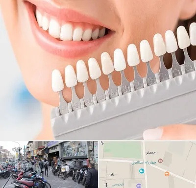 متخصص لمینت دندان در چهارراه استانبول