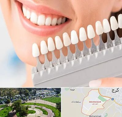متخصص لمینت دندان در مهرشهر کرج 