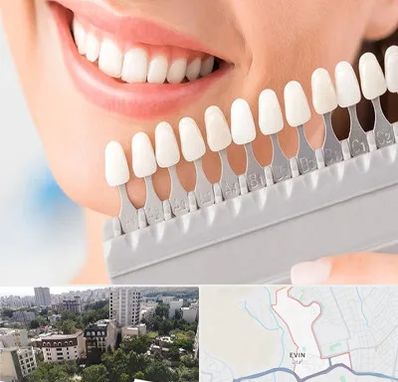 متخصص لمینت دندان در اوین