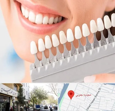 متخصص لمینت دندان در مجیدیه جنوبی