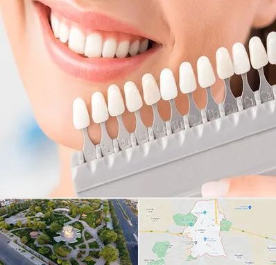 متخصص لمینت دندان در کاشمر