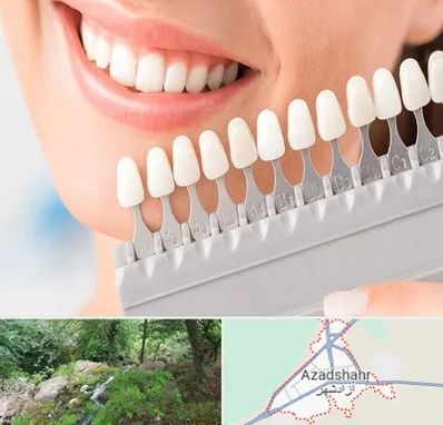 متخصص لمینت دندان در آزادشهر