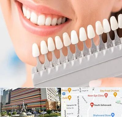 متخصص لمینت دندان در سهروردی 