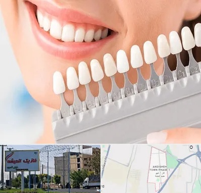 متخصص لمینت دندان در فاز یک اندیشه