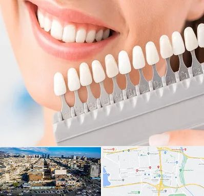 متخصص لمینت دندان در شهرک راه آهن