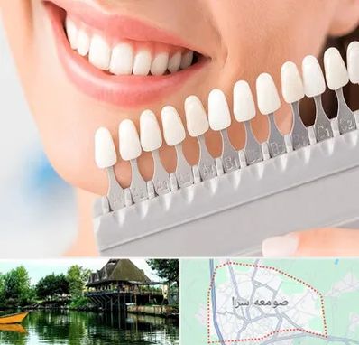 متخصص لمینت دندان در صومعه سرا