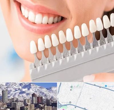 متخصص لمینت دندان در ازگل