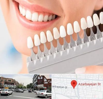 متخصص لمینت دندان در خیابان آذربایجان