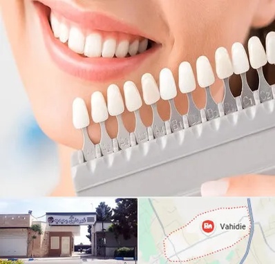 متخصص لمینت دندان در وحیدیه شهریار